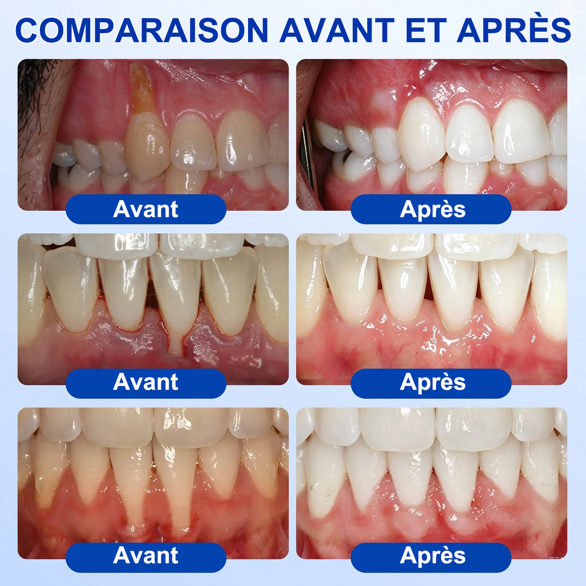 🇫🇷🦷 PURELORA® GumRevive Gel réparateur parodontal (Pour les saignements de gencives, la récession gingivale et les dents mobiles)