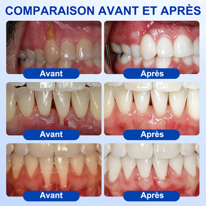 🇫🇷🦷 PURELORA® GumRevive Gel réparateur parodontal (Pour les saignements de gencives, la récession gingivale et les dents mobiles)