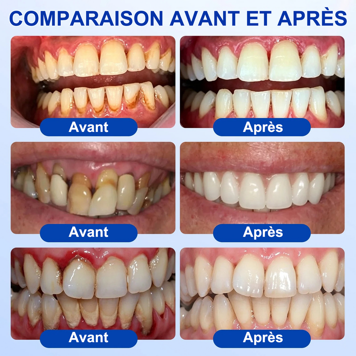 🇫🇷🦷 PURELORA® GumRevive Gel réparateur parodontal (Pour les saignements de gencives, la récession gingivale et les dents mobiles)