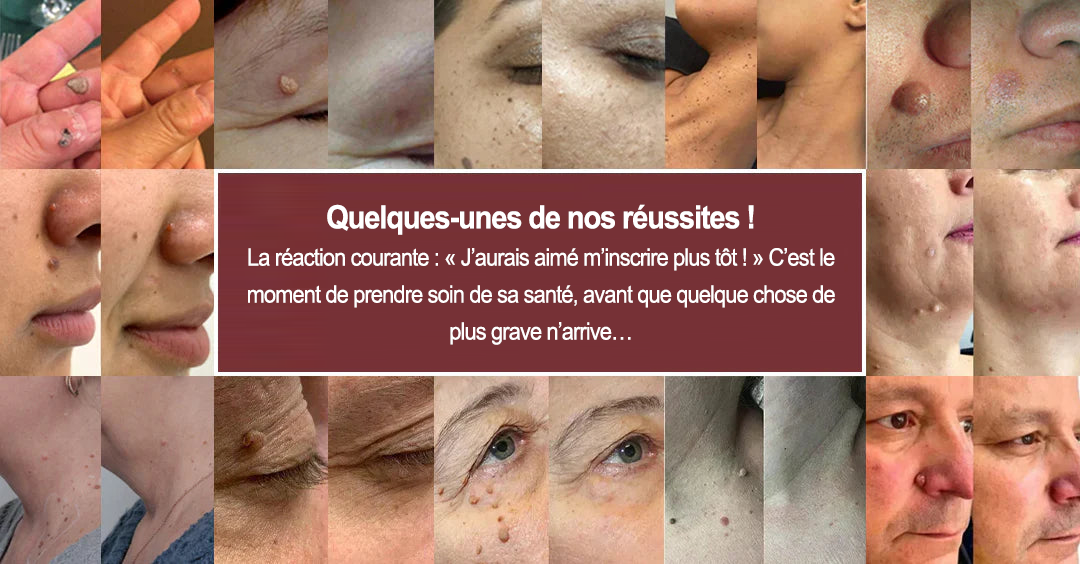 ✨Curalona® Patch micro-aiguilles et hydrocolloïde 2 en 1🍀 | Élimine les grains de beauté en relief, l'acné, les verrues planes et les acrochordons | Atténue les rides, les cicatrices et les imperfections | Patchs invisibles pour le visage et le corps