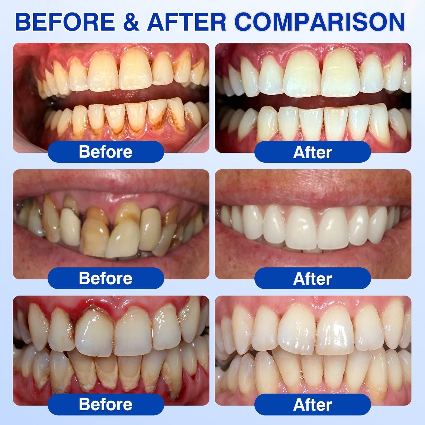 🇺🇸🦷PURELORA® GumRevive Periodontal Repair Gel (For Bleeding Gums, Gum Recession & Loose Teeth)