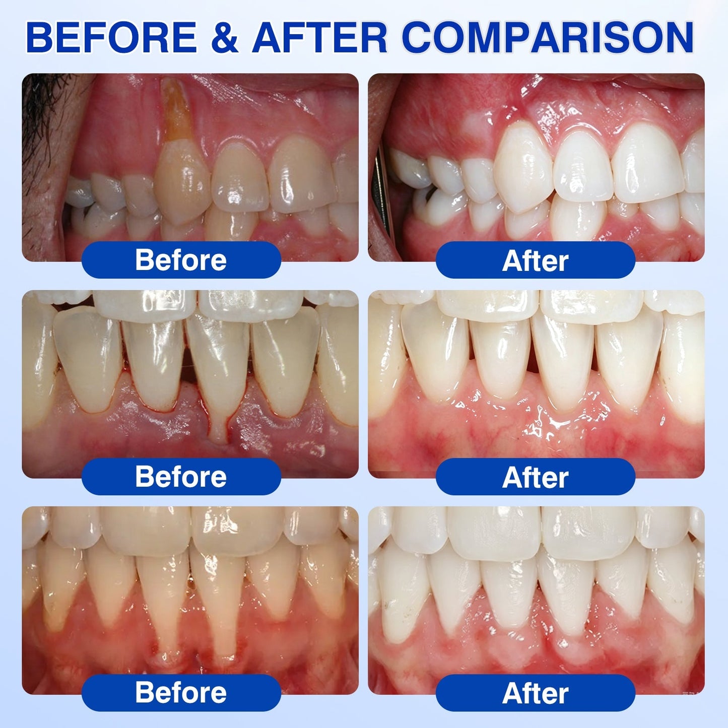 🇺🇸🦷PURELORA® GumRevive Periodontal Repair Gel (For Bleeding Gums, Gum Recession & Loose Teeth)