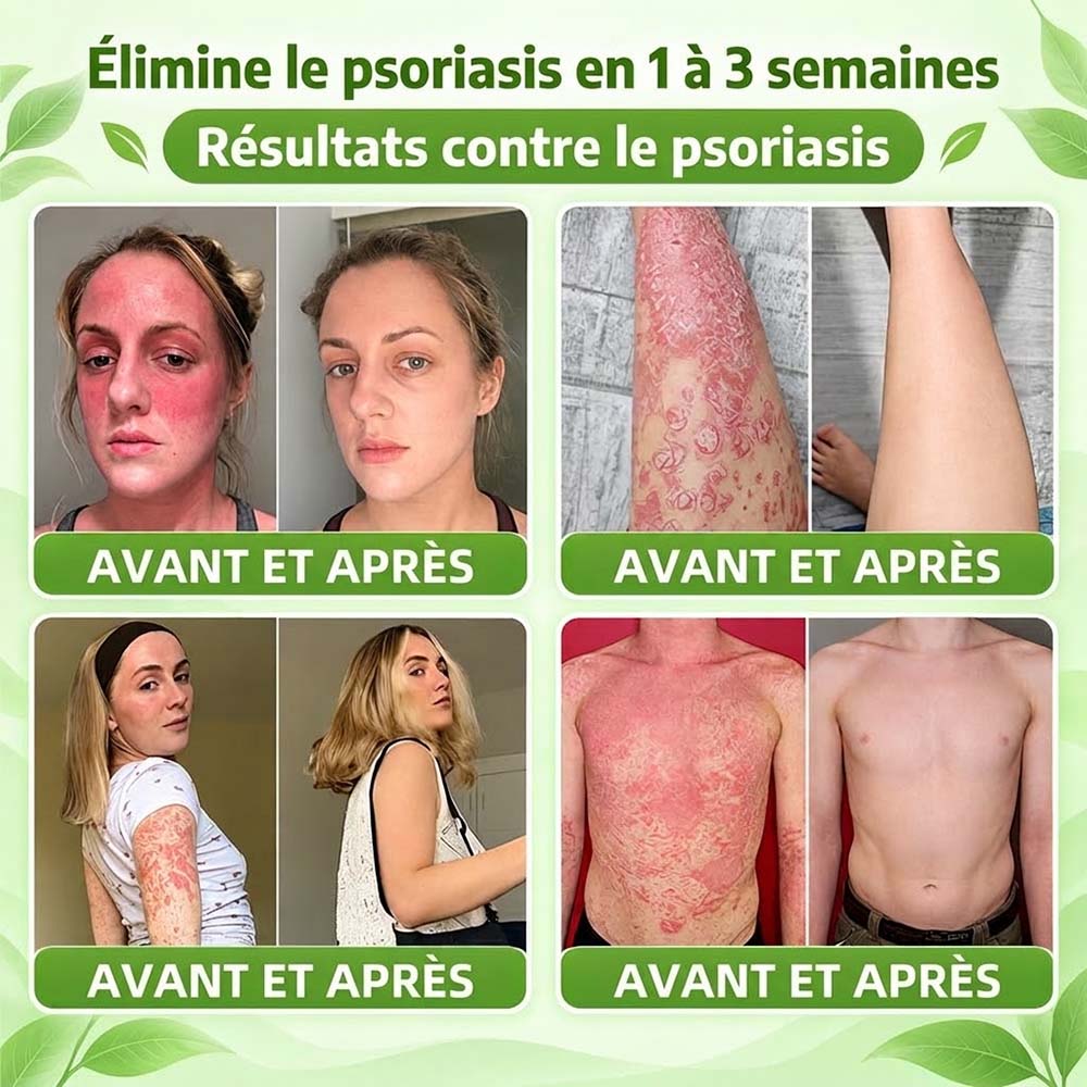 Boutique officielle | 💧 Purelora® Crème 10-en-1 au peptide antagoniste IL-23R + indirubine pour peaux sujettes au psoriasis — aide à réduire rougeurs, squames, sécheresse et démangeaisons et à soutenir la barrière cutanée.