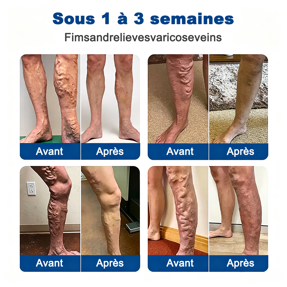🇫🇷✨👨‍⚕️ CURALONA® VeinTarget Patch à Micro-Aiguilles ⚡ Soulagement rapide, soutien longue durée
