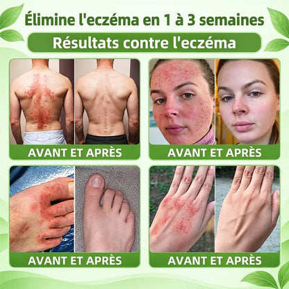 Boutique officielle | 💧 Purelora® Crème 10-en-1 au peptide antagoniste IL-23R + indirubine pour peaux sujettes au psoriasis — aide à réduire rougeurs, squames, sécheresse et démangeaisons et à soutenir la barrière cutanée.
