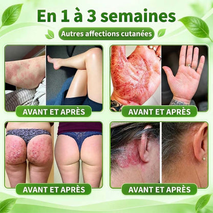 Boutique officielle | 💧 Purelora® Crème 10-en-1 au peptide antagoniste IL-23R + indirubine pour peaux sujettes au psoriasis — aide à réduire rougeurs, squames, sécheresse et démangeaisons et à soutenir la barrière cutanée.