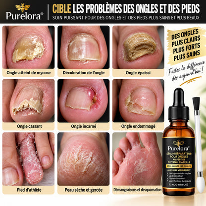 Sérum réparateur pour ongles et pieds Purelora® à base de peptides de venin d'abeille, pour le soin des mycoses des ongles, des ongles jaunes, des ongles épais et le soutien à la récupération du pied d'athlète.