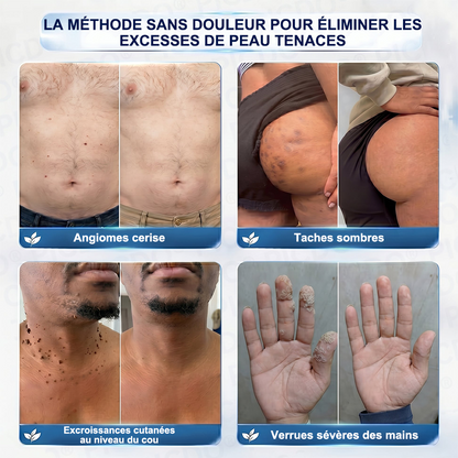 Crème PURELORA® pour l'élimination des acrochordons et des imperfections en 7 jours (formule indolore – sans cicatrice) 🌹🌹
