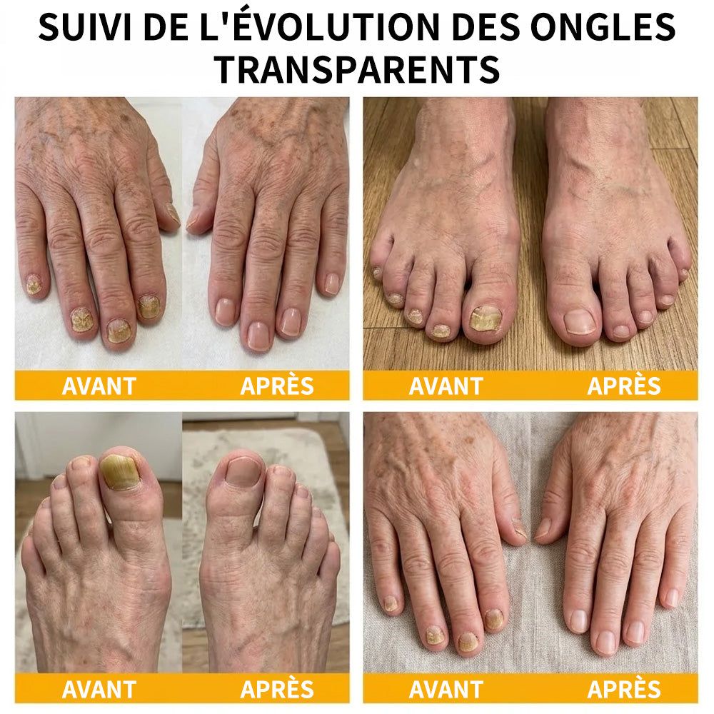 Sérum réparateur pour ongles et pieds Purelora® à base de peptides de venin d'abeille, pour le soin des mycoses des ongles, des ongles jaunes, des ongles épais et le soutien à la récupération du pied d'athlète.