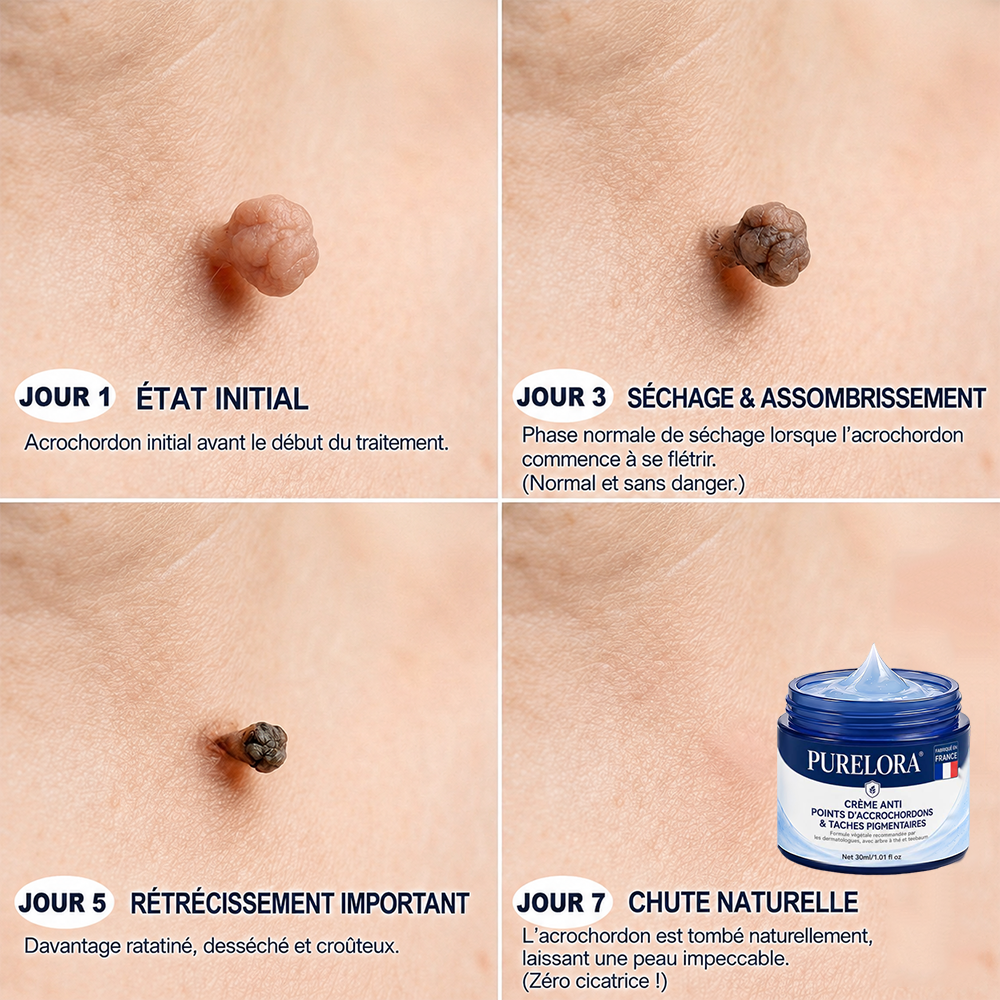 Crème PURELORA® pour l'élimination des acrochordons et des imperfections en 7 jours (formule indolore – sans cicatrice) 🌹🌹