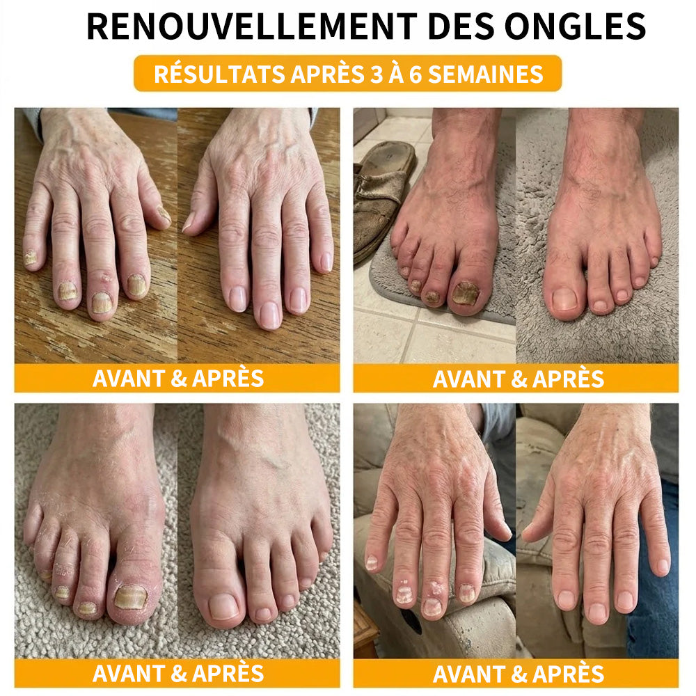 Sérum réparateur pour ongles et pieds Purelora® à base de peptides de venin d'abeille, pour le soin des mycoses des ongles, des ongles jaunes, des ongles épais et le soutien à la récupération du pied d'athlète.