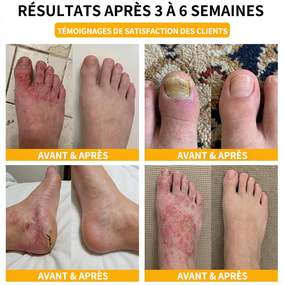 Sérum réparateur pour ongles et pieds Purelora® à base de peptides de venin d'abeille, pour le soin des mycoses des ongles, des ongles jaunes, des ongles épais et le soutien à la récupération du pied d'athlète.