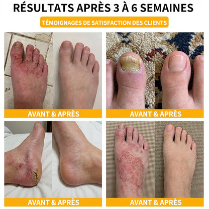Sérum réparateur pour ongles et pieds Purelora® à base de peptides de venin d'abeille, pour le soin des mycoses des ongles, des ongles jaunes, des ongles épais et le soutien à la récupération du pied d'athlète.