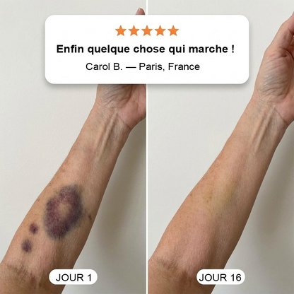 💥Plus de 100 000 unités vendues💕 - Crème PURELORA® pour réparer les ecchymoses et renforcer la peau