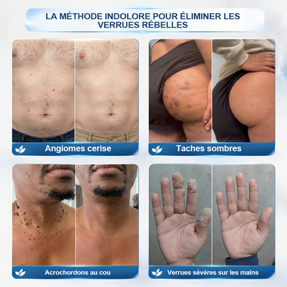 𝐁𝐨𝐮𝐭𝐢𝐪𝐮𝐞 𝐨𝐟𝐟𝐢𝐜𝐢𝐞𝐥𝐥𝐞 𝐝𝐞 𝐥𝐚 𝐦𝐚𝐫𝐪𝐮𝐞 |✅💎Purelora® Éliminateur de taches et d’excroissances cutanées en 7 jours (Roller sans douleur, sans cicatrice)