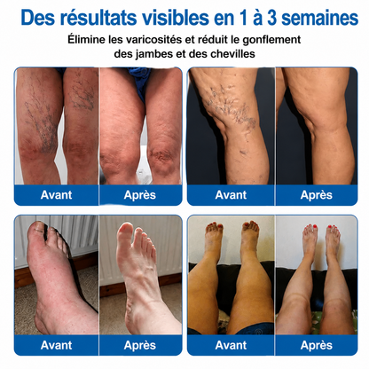 🇫🇷🏆✅️🏃 Patch à micro-aiguilles Curalona® pour le soin ciblé des veines ⚡ Soulagement rapide, résultats durables