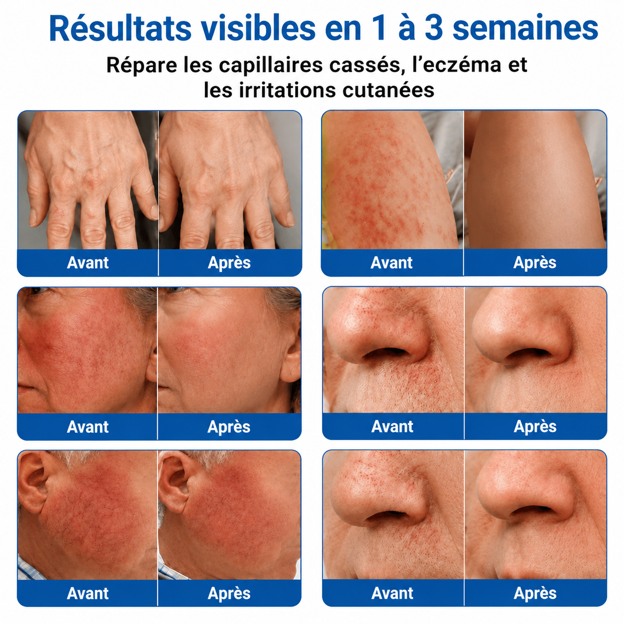 🇫🇷🏆✅️🏃 Patch à micro-aiguilles Curalona® pour le soin ciblé des veines ⚡ Soulagement rapide, résultats durables